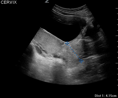 what-is-placenta-previa-askdrmanny