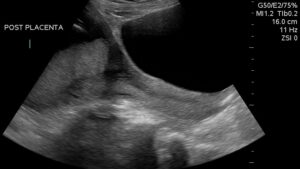 Advanced Placenta, Cervix and Umbilical Cord