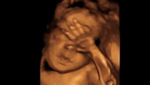 Ultrasound in the Third Trimester