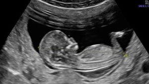 Introduction to OB GYN Ultrasound