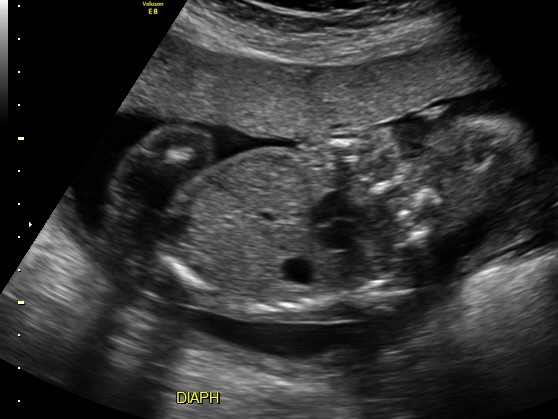 Featured Image for Fetal Breathing