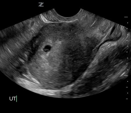 Featured Image for Re-Dating in the First Trimester