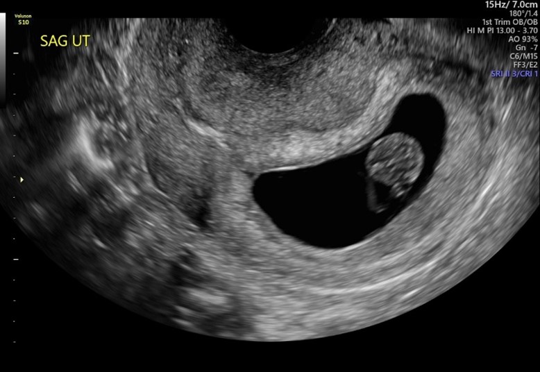 small retroverted uterus        
        <figure class=