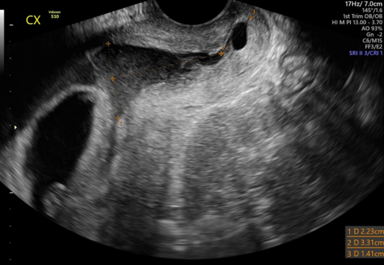 First Trimester Cervical Funneling - Sonosession