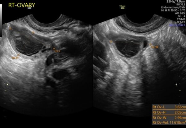 Retained Products of Conception (RPOC) - Sonosession
