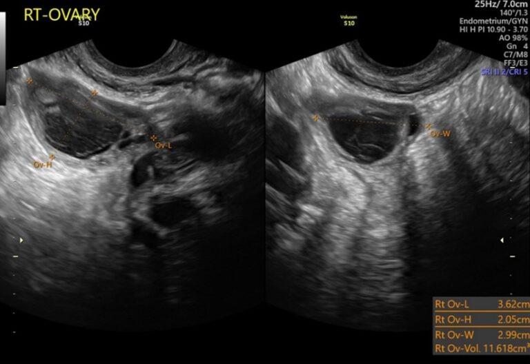 Retained Products of Conception (RPOC) - Sonosession