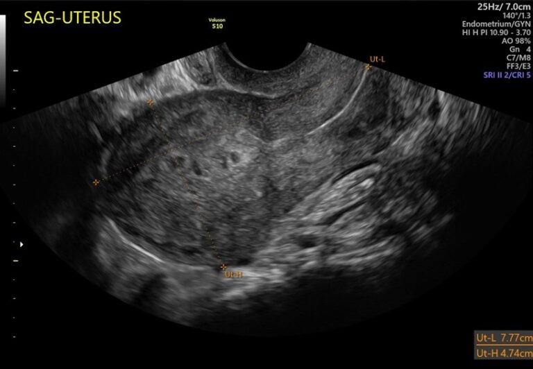 Retained Products of Conception (RPOC) - Sonosession