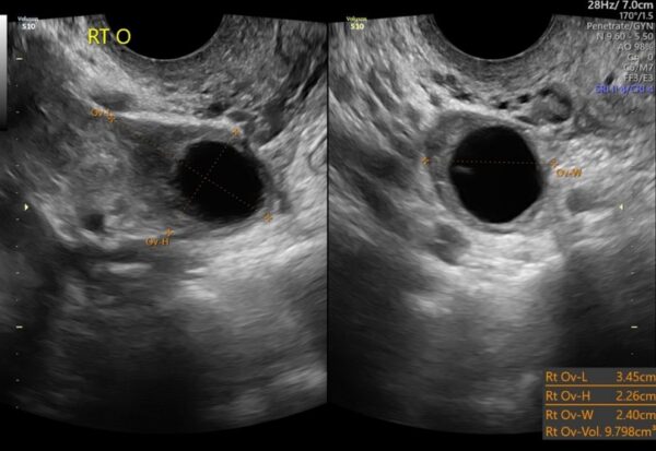 Retained Products of Conception (RPOC) - Sonosession